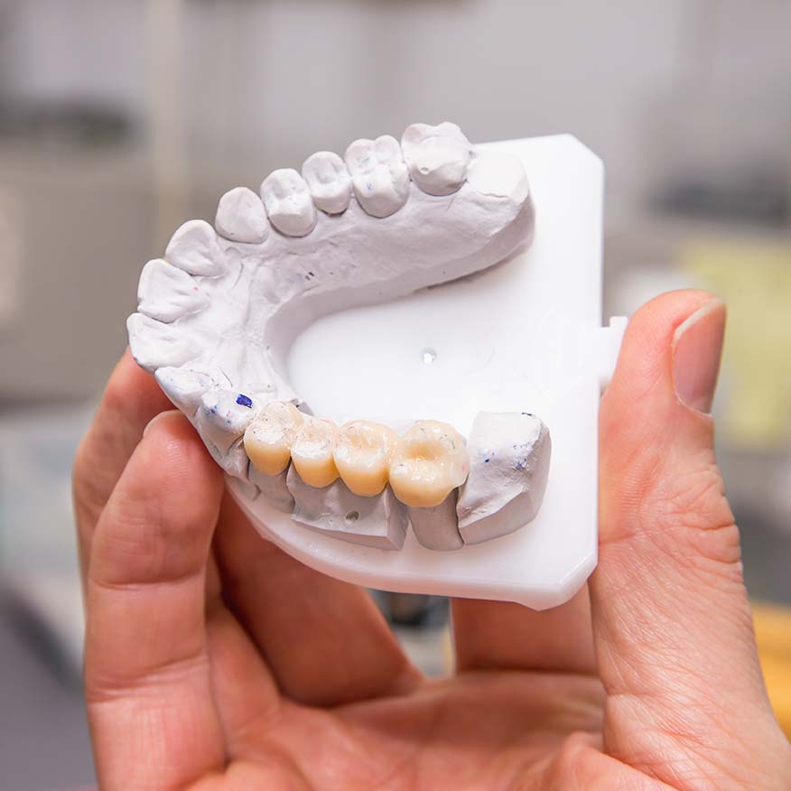 Full-Mouth Reconstruction in Lodi, CA