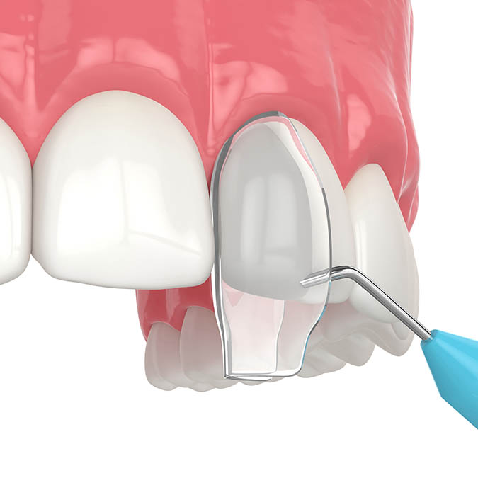 Tooth Bonding in Lodi, CA